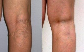 Before and after the use of Varicobooster 1