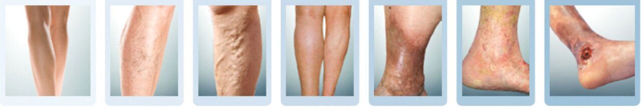 stages of development of varicose veins of the legs