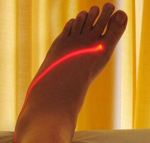 laser treatment of varicose veins on the legs