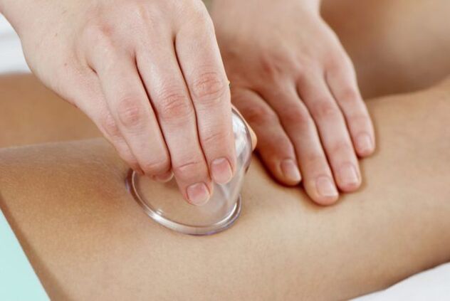 cupping massage for varicose veins