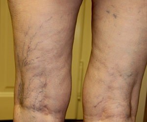 varicose veins-enlargement of veins