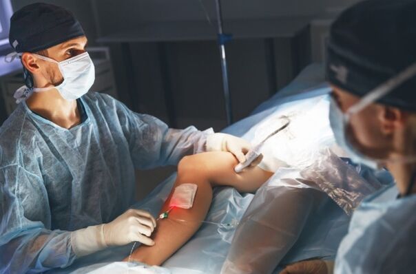 laser varicose vein surgery