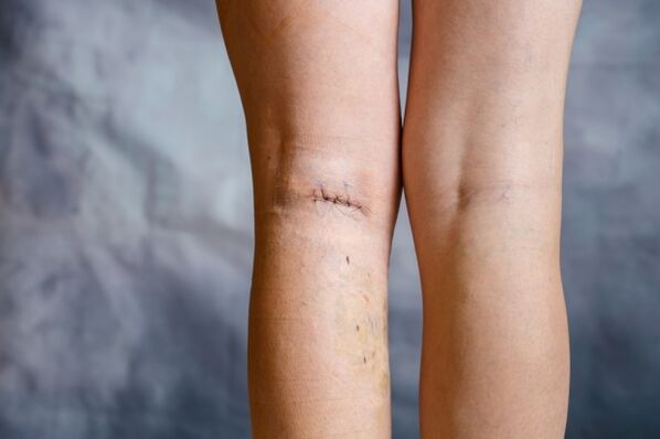seam on the leg after varicose vein surgery