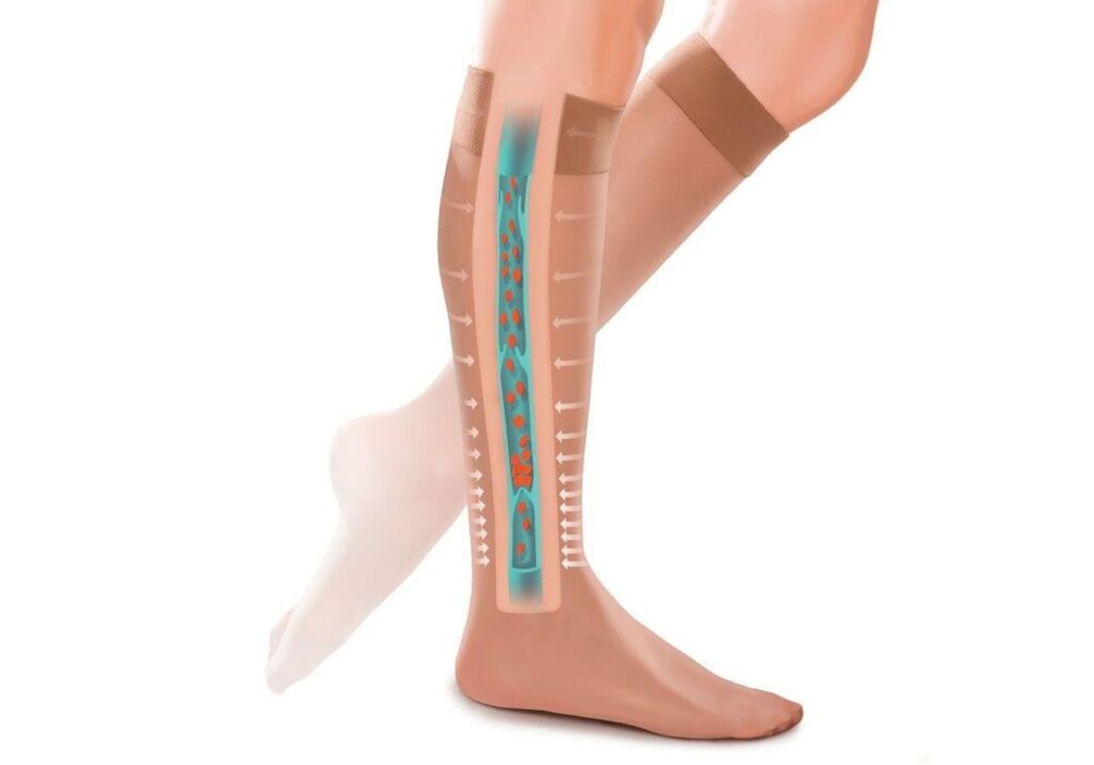the effect of compression stockings on legs with varicose veins