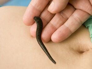 leech for the treatment of varicose veins