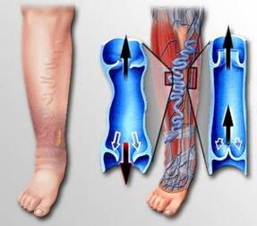 blood flow in the leg with varicose veins
