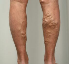 knots on the legs with varicose veins