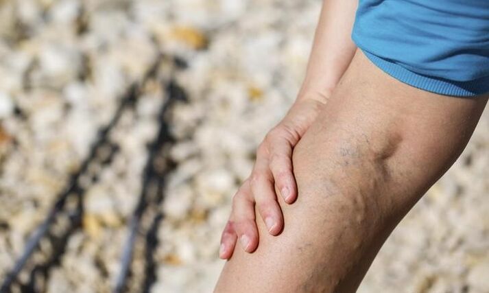 pain with varicose veins