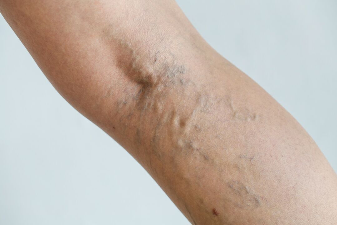 varicose veins on the leg photo 1