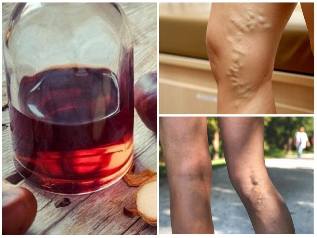 from-varicose veins
