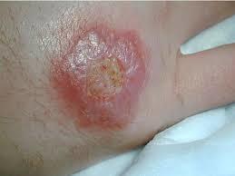 ulcers on the skin,