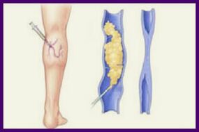 Sclerotherapy is a popular method to get rid of varicose veins on the legs