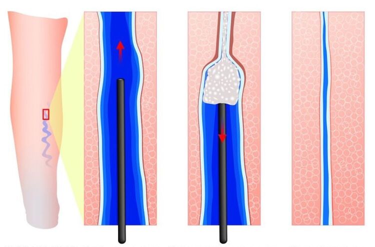 sclerotherapy of varicose veins of the lips