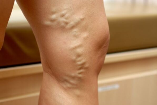 varicose veins on the leg with varicose veins of the small pelvis