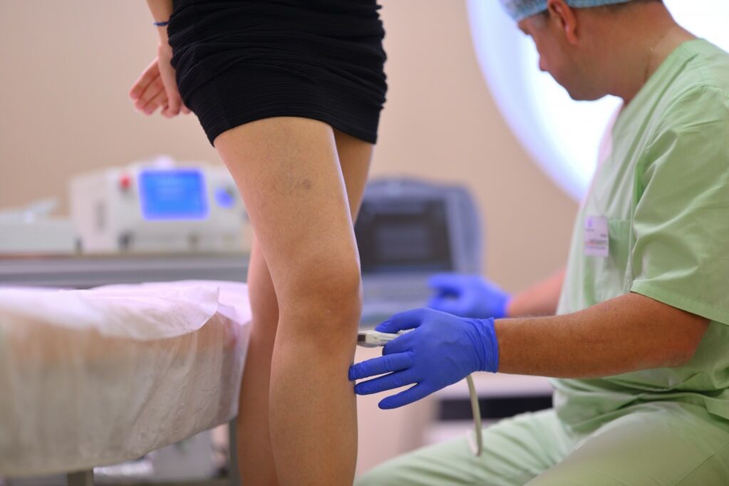 treatment of varicose veins on the legs