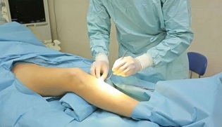 how is the operation for varicose veins