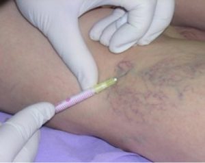 pain with varicose veins treatment fluid