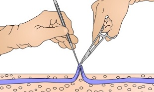 varicose vein surgery