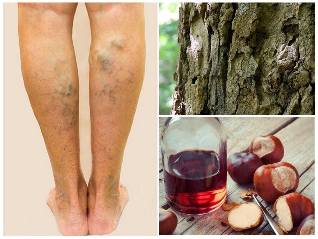 treatment of varicose veins veins on legs folk remedies