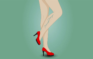 Varicose veins on a woman's legs