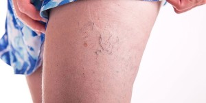 varicose veins treatment methods