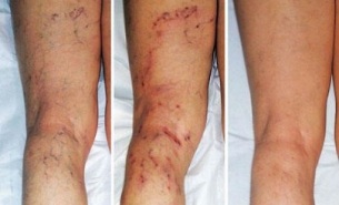 symptoms of varicose veins in the legs
