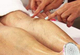varicose veins on the legs in women