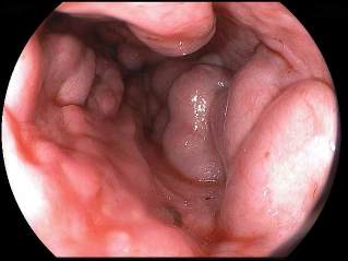 varicose veins of the esophagus