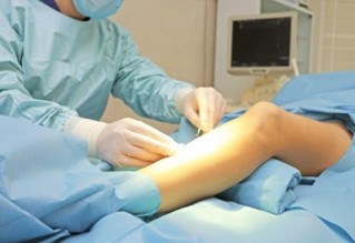 how to cure varicose veins
