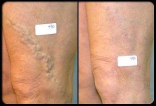 Before and after venous surgery
