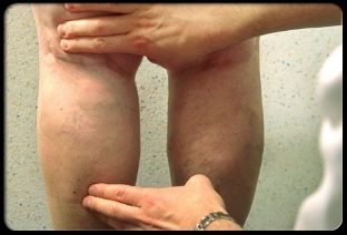 Doctor examines legs with varicose veins