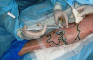 how to get rid of varicose veins surgery