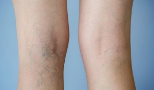 signs of varicose veins in the legs in women