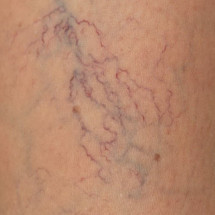 Manifestations of varicose veins