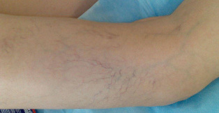Vascular asterisks on legs